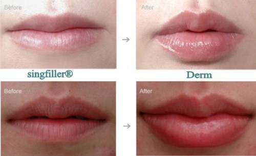 China 10 years factory for derma fillers lip fillers