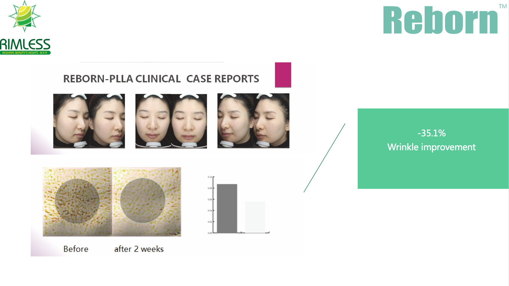 2 ml 5 ml Reborn PLLA Hydrogel för att ta bort melaninet i kroppen