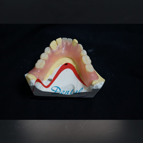 Valplast® And TCS Removable Partial Denture