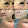 PLLA Cheek Filler before and after