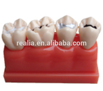 Sealantant Demonstration Teeth Model