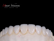 Ultra thin porcelain veneer