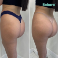 Long-lasting Natural Filler For Female Buttocks Contouring