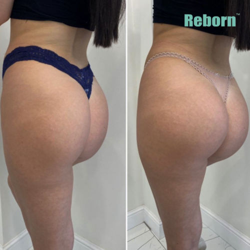 Beauty Charming Butt Lifting Injectable Collagen Booster