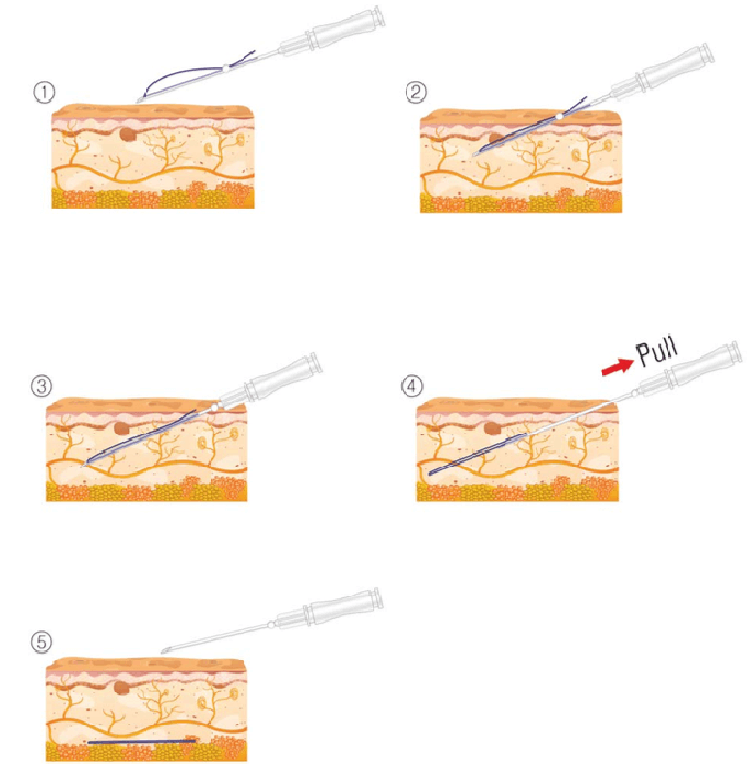 Thread Lift