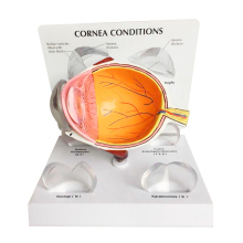 Cataract Eye Pathological Model: Human Eyeball Anatomical Disease Model for Medical Education