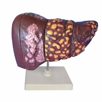 Disease liver model