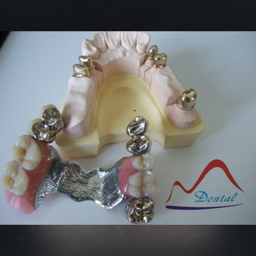 Dental Nice Looking Telescopic Crown