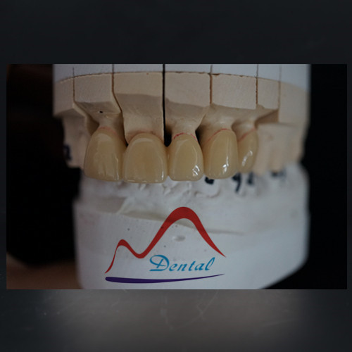 Dental IPS E-max All Ceramic Crown