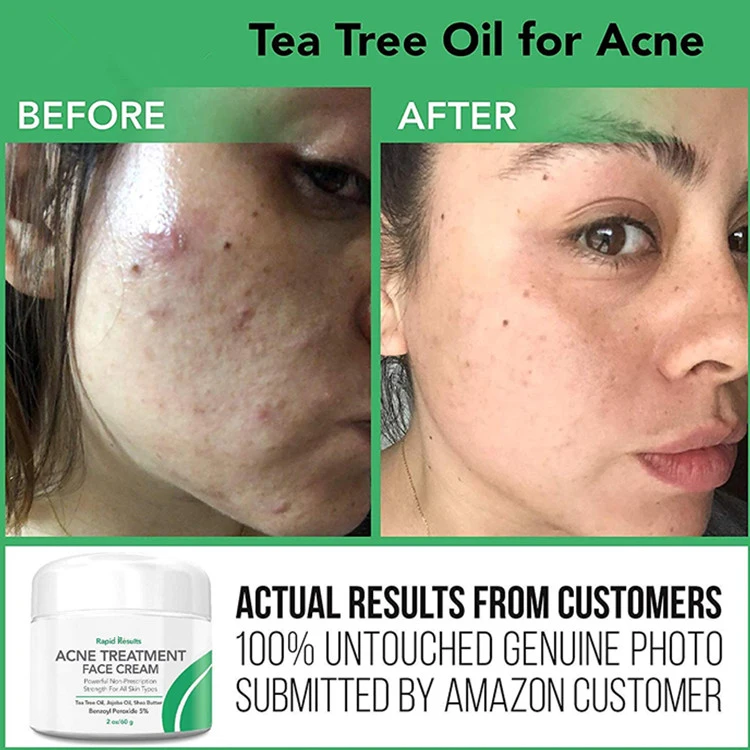 Natural Acne Treatment Face Cream Hormonal & Cystic Acne Pimple Cream