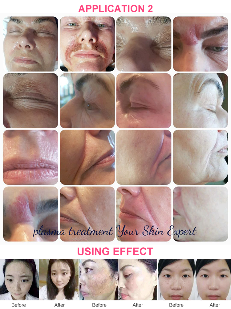 Beauty facial acne scar removal sweep spot point mole pen  plasma