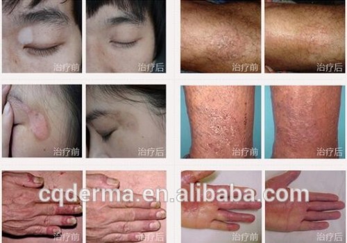 portable handheld home use 308nm Mini excimer vitiligo treatment device for vitiligo