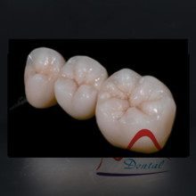 High Quality Dental IPS Emax Cosmetic Crown All Ceramics
