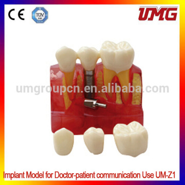 Dental Dentist Demonstration Teeth Model Implant Analysis Crown Bridge good