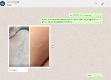 980 Diode Laser Vascular Veins Removal Machine