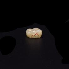 Posterior IPS e.max Press Prosthesis