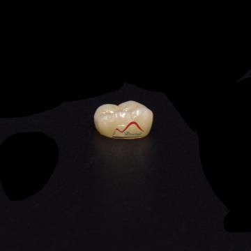 Posterior IPS e.max Press Prosthesis