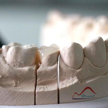 Dental Composite Resin Onlay