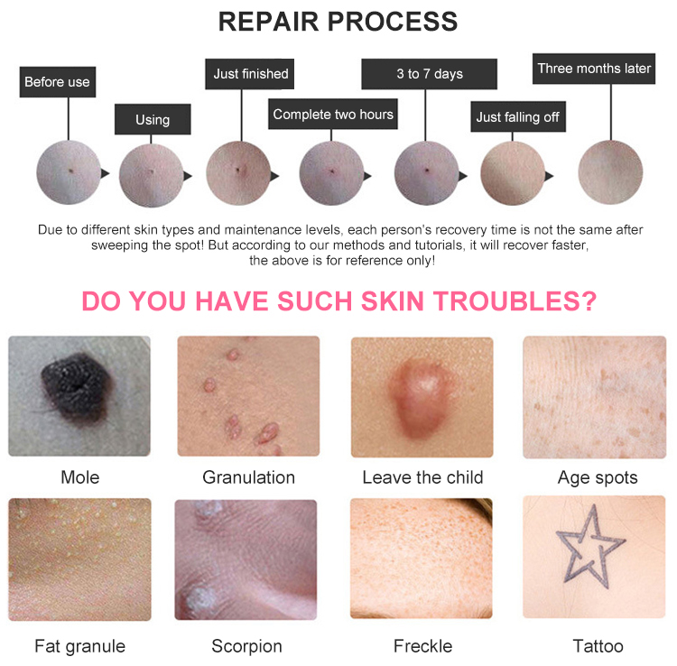 Beauty facial acne scar removal sweep spot point mole pen  plasma