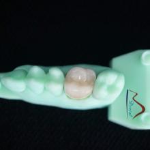 3D Printing Model PFM Cocr Crown