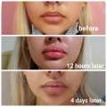Hyaluronic Acid Dermal Filler Yviore Serum Face Lip