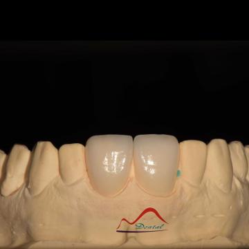 Dental Aesthetic Porcelain Veneers