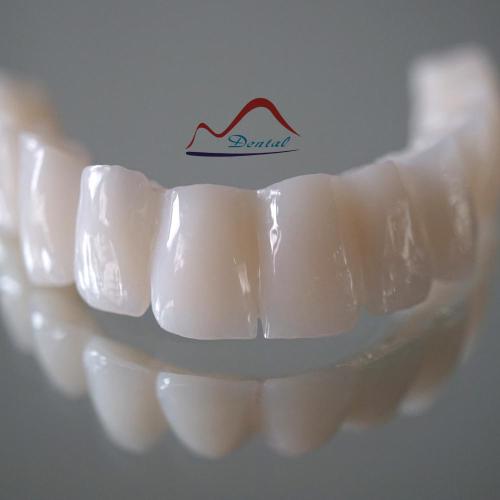 Maxillary Temporary Bridge With Wire