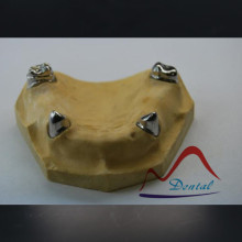 Dental Telescopic Crown and Bridge