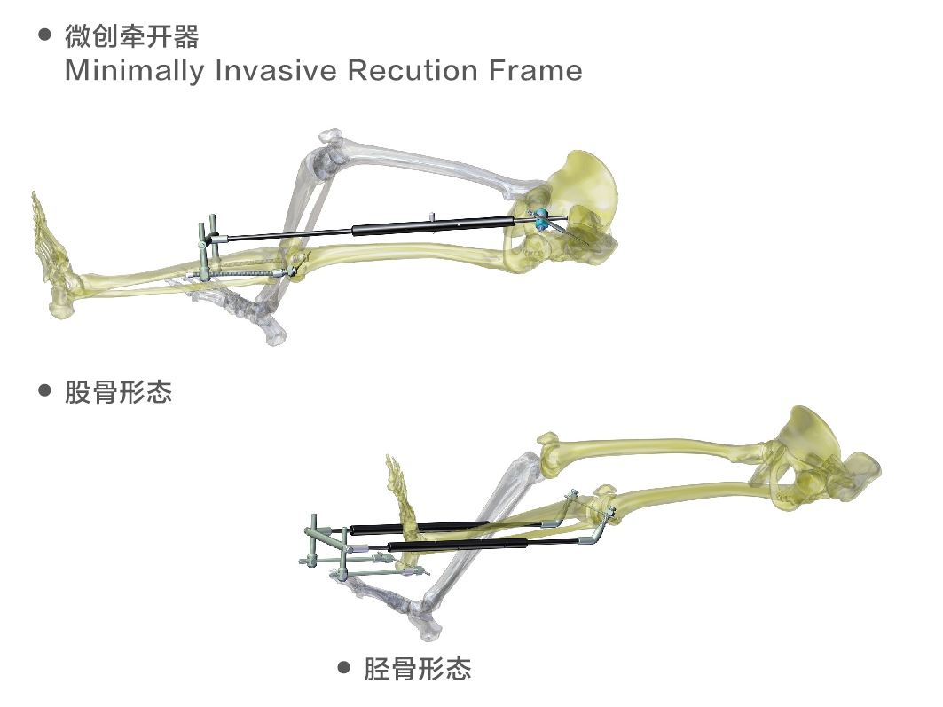 bingkai traksi minimal invasif untuk anggota badan minimally invasive traction frame for limbs