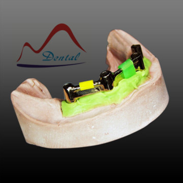 Implant Dolder Bar OverDenture