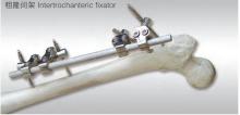 orthopedic external fixation Femoral External Fixator