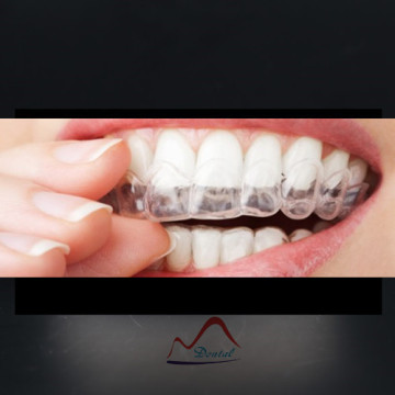 Bleaching Tray for Brighter Smile