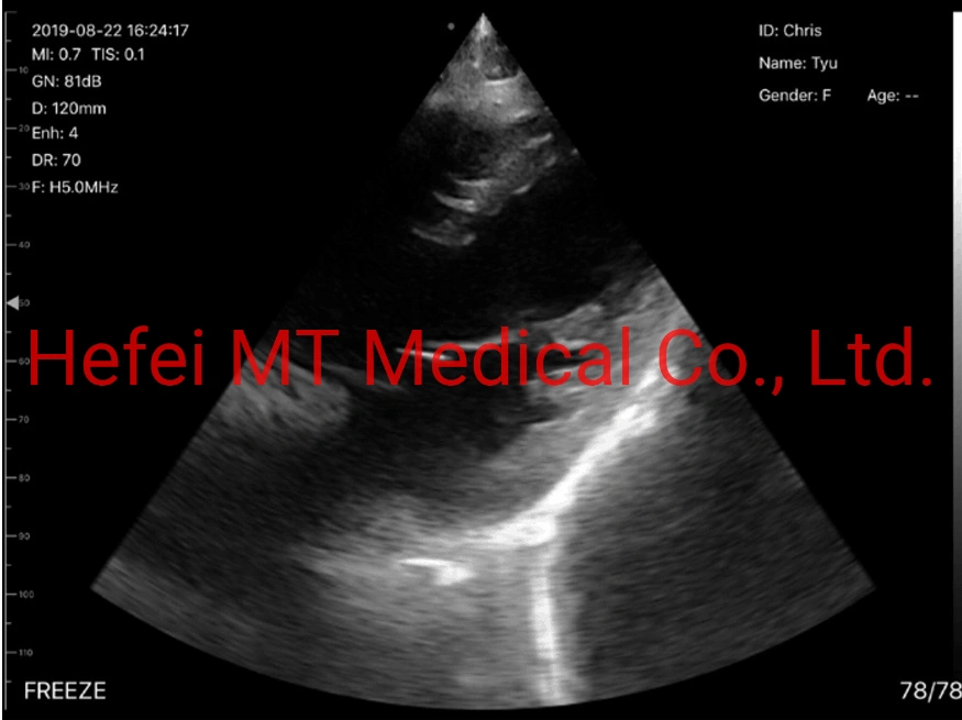 Ultrasound Cardaic Phased Array Wireless Ultrasound Probe