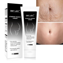 Omy Lady Natural Herbal Cream for Acne Scars and Stretch Marks Removal
