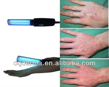 UVB 311nm UVB lamps for Psoriasis Vitiligo Eczema