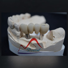 Dental Implant Crown and Bridge mostly Porcelain Resistant