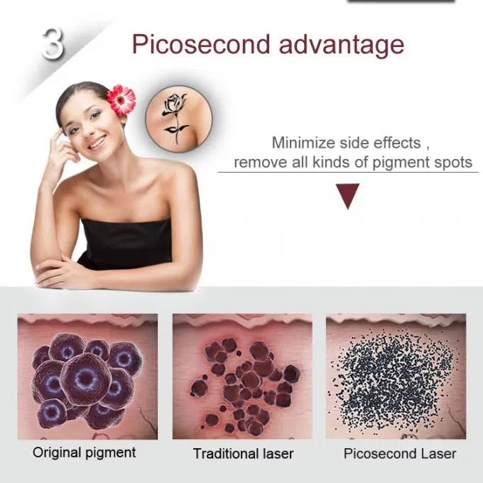 Láser de picosegundos 4 Picosecond Laser 4