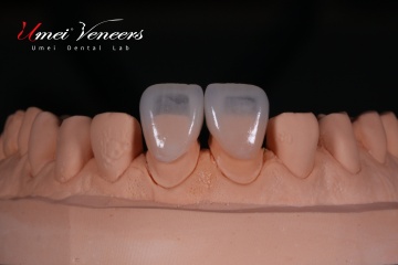 Natural Translucent Cast Porcelain Veneers