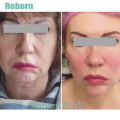 Medical Cosmetic Filler for Skin