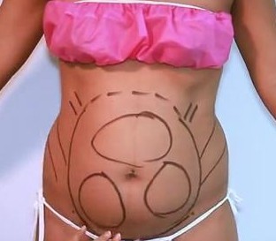 Plastic Surgery Laser