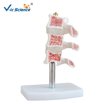 Human Osteoporosis Medical Model