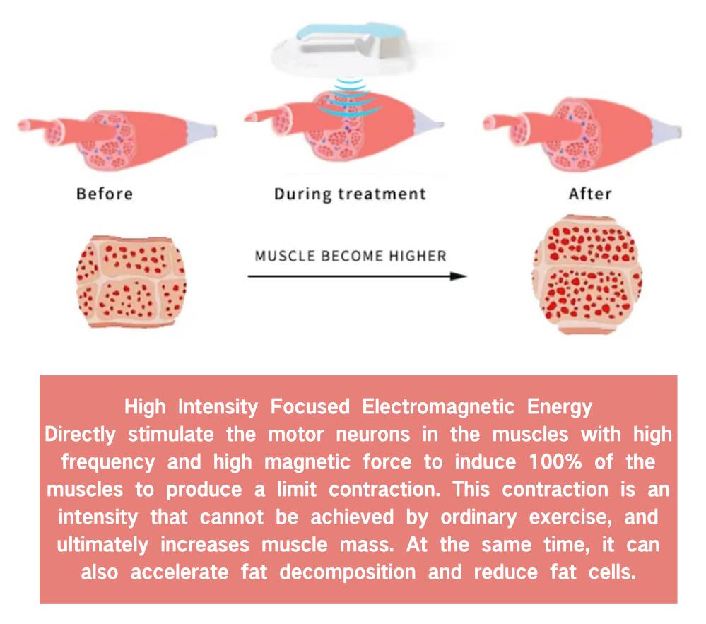 Working theory of Cryo & EMS 2 in 1 Machine