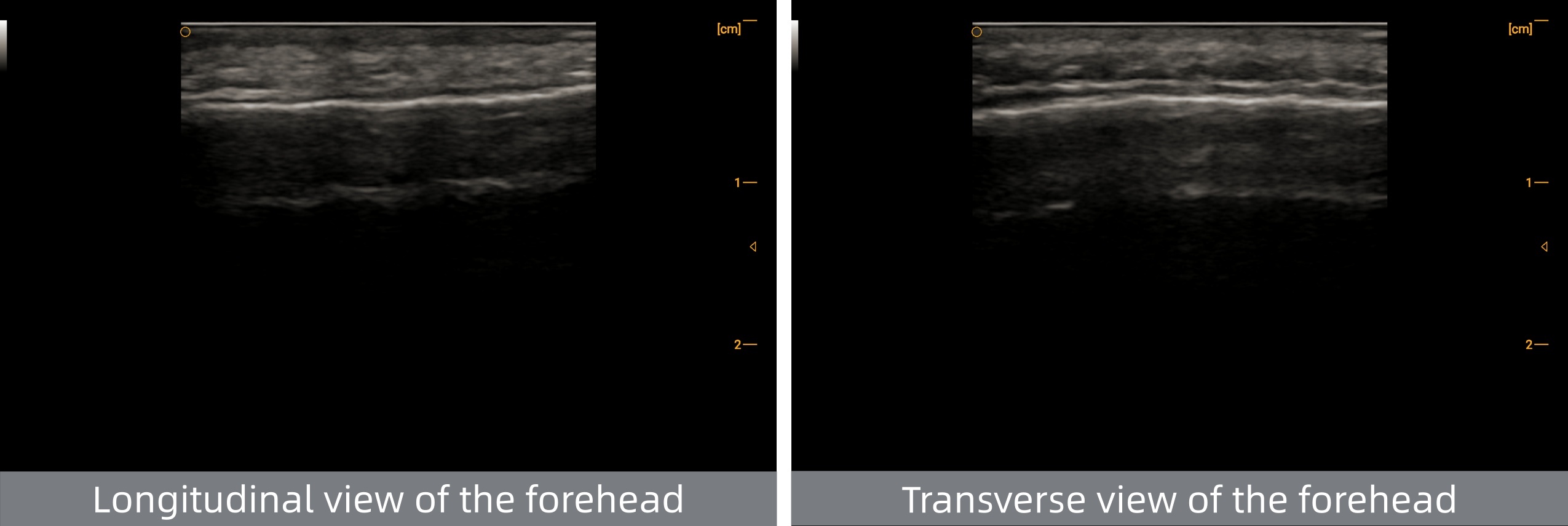 Yüksek Frekanslı El Tipi Ultrason Probu – Alın Görüntüleme High-Frequency Handheld Ultrasound Probe – Forehead Imaging