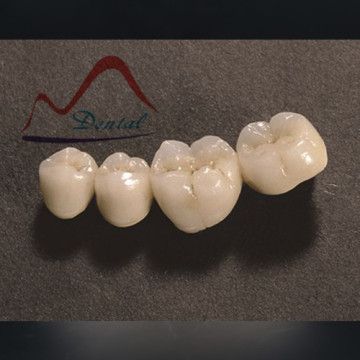 PFM Semi-Precious Crown and Bridge