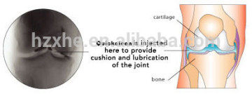 Medical Use Hyaluronic Acid for Osteoarthritis