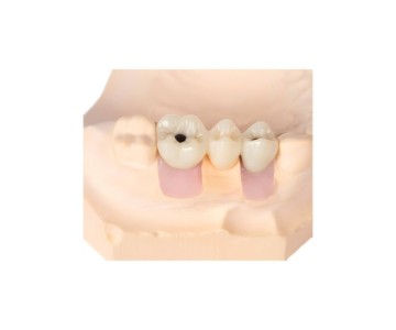 Anatomical Implant Restoration Crown