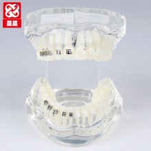Transparent Orthodontic Demo Model with Ceramic and Metal Brackets