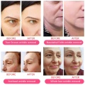 cosmetic sculptra filler forcheeks jowls face lips lift