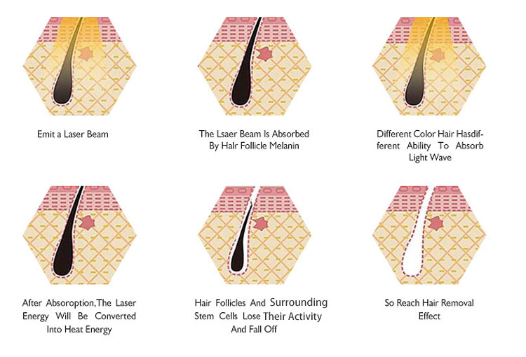 Cartucho de depilación láser E One E One Laser Hair Removal Cartridge