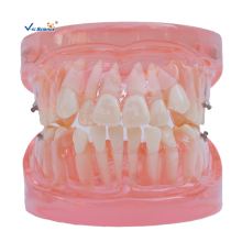 Orthodontic Model Ortho?Metal or Ceramic Bracket